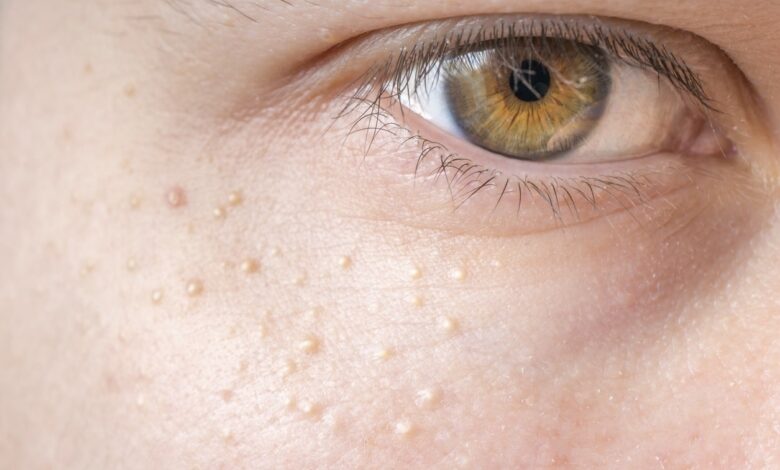 Understanding Bumps: What They Are and Why They Matter bumps